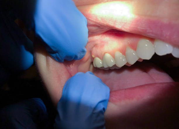 Best Knocked-Out Tooth Emergency  in Duncan Falls, OH